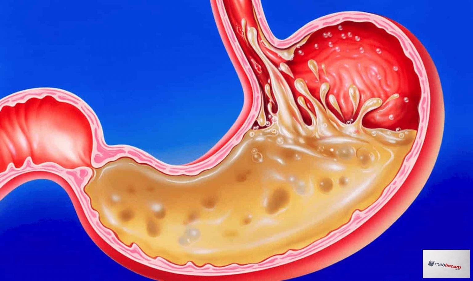 Düşük mide asidine sahip olmanın yan etkileri nelerdir?