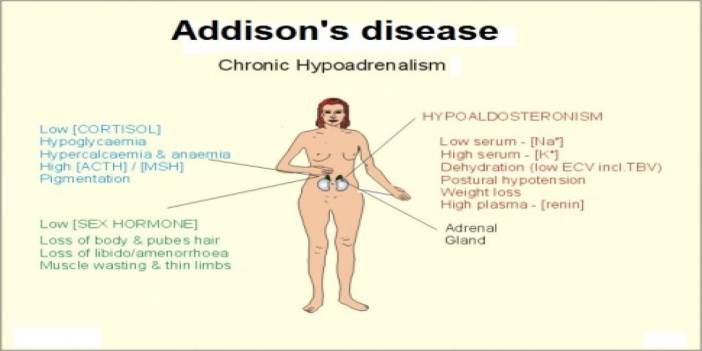 Understanding Addison's Disease